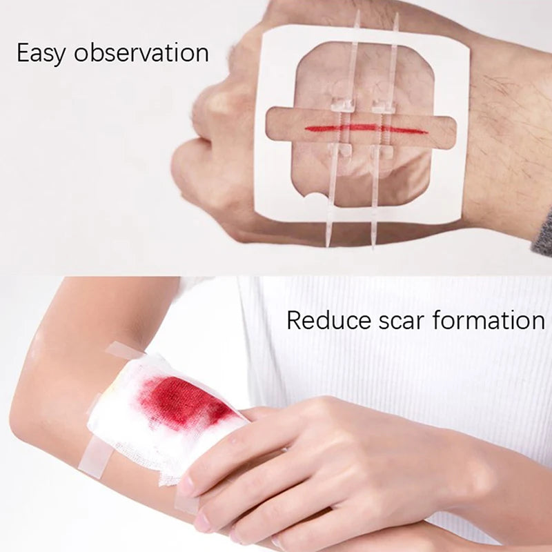 Painless Suture Adhesive Wound Closure Device