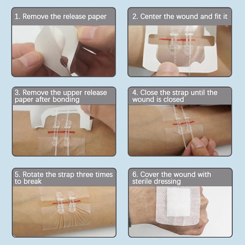 Painless Suture Adhesive Wound Closure Device